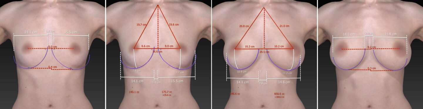 VECTRA XTによる乳房手術のシミュレーション