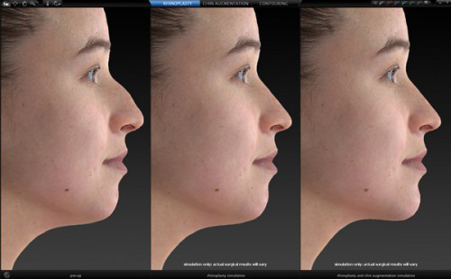 顔面の部位別解析・手術シミュレーション