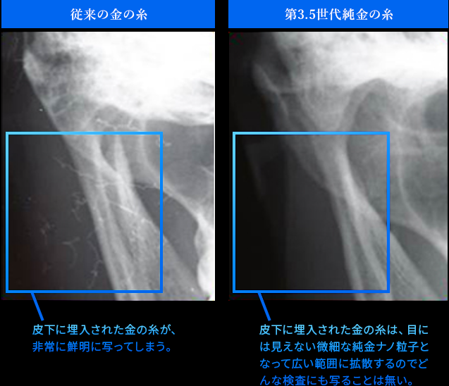 レントゲン写真